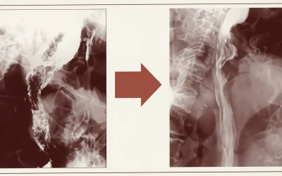 Esophagus Cancer: 10-cm Tumor Disappeared